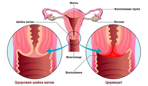 Удаление инородных тел из влагалища - цены в клинике ЛеВита