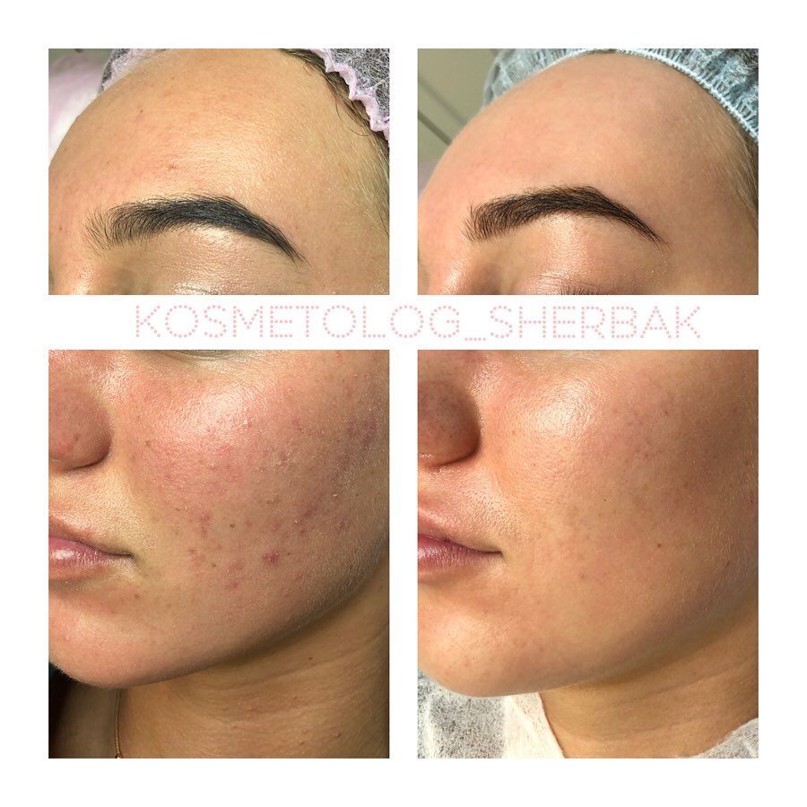 Индивидуальный подбор домашнего ухода в клинике PradusCOSMO, Санкт-Петербург. Косметологический анализ кожи и рекомендация профессиональной косметики