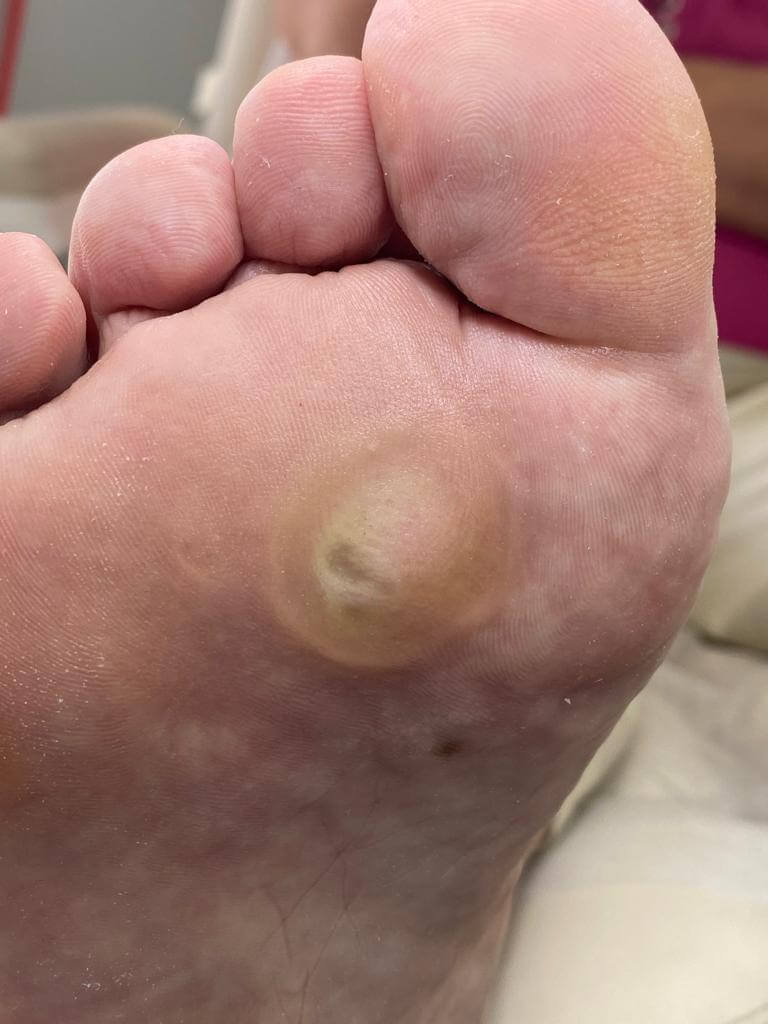 Удаление натоптышей