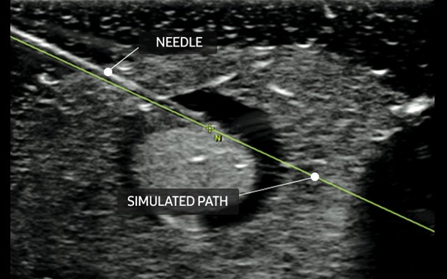 S-Tracking - навигация биопсийной иглы под УЗ-контролем (эхограмма)