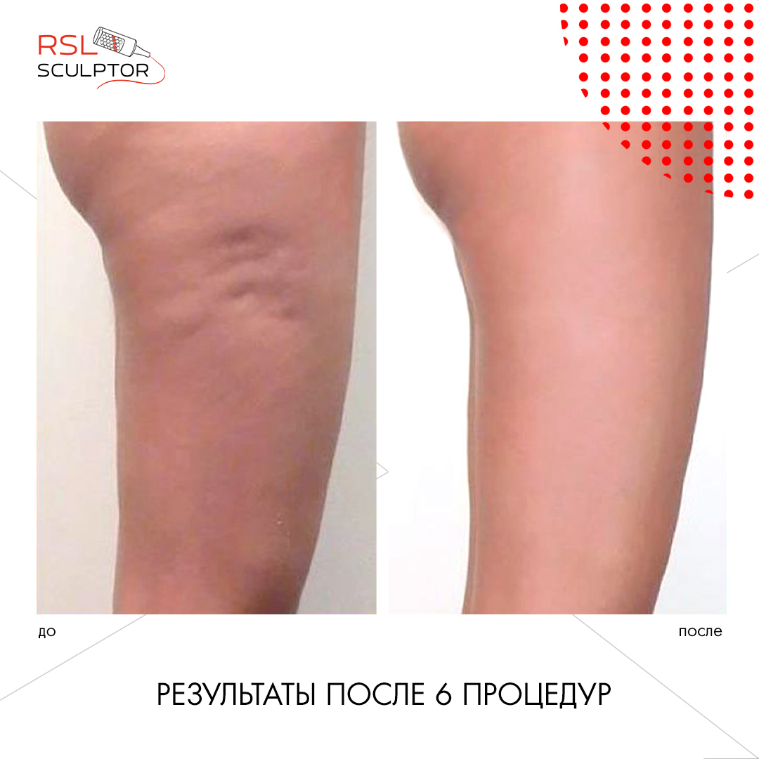 Голень до и после 6 процедур РСЛ-скульптурирования