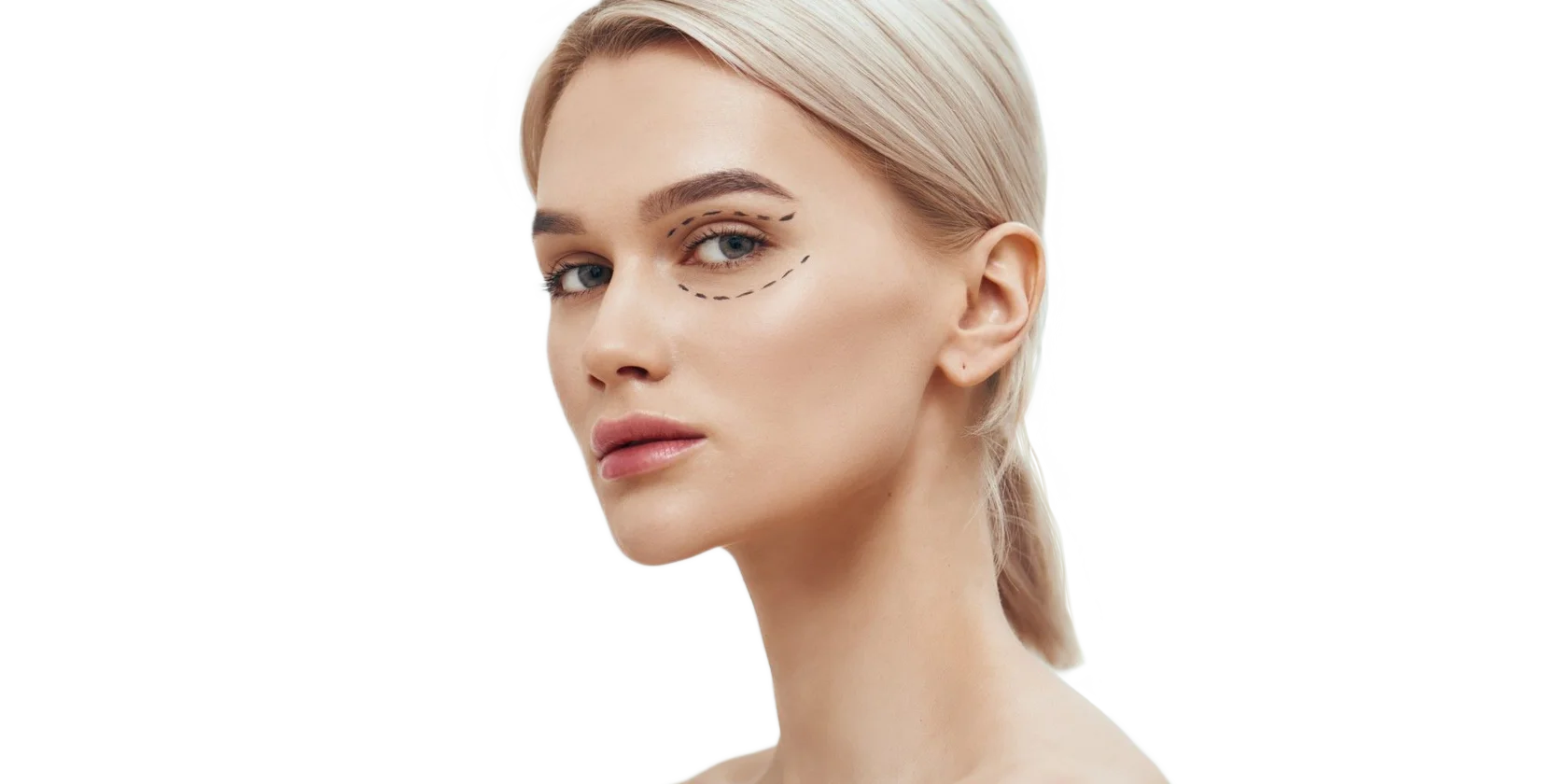 Блефаропластика в Москве — пластика верхних и нижних век