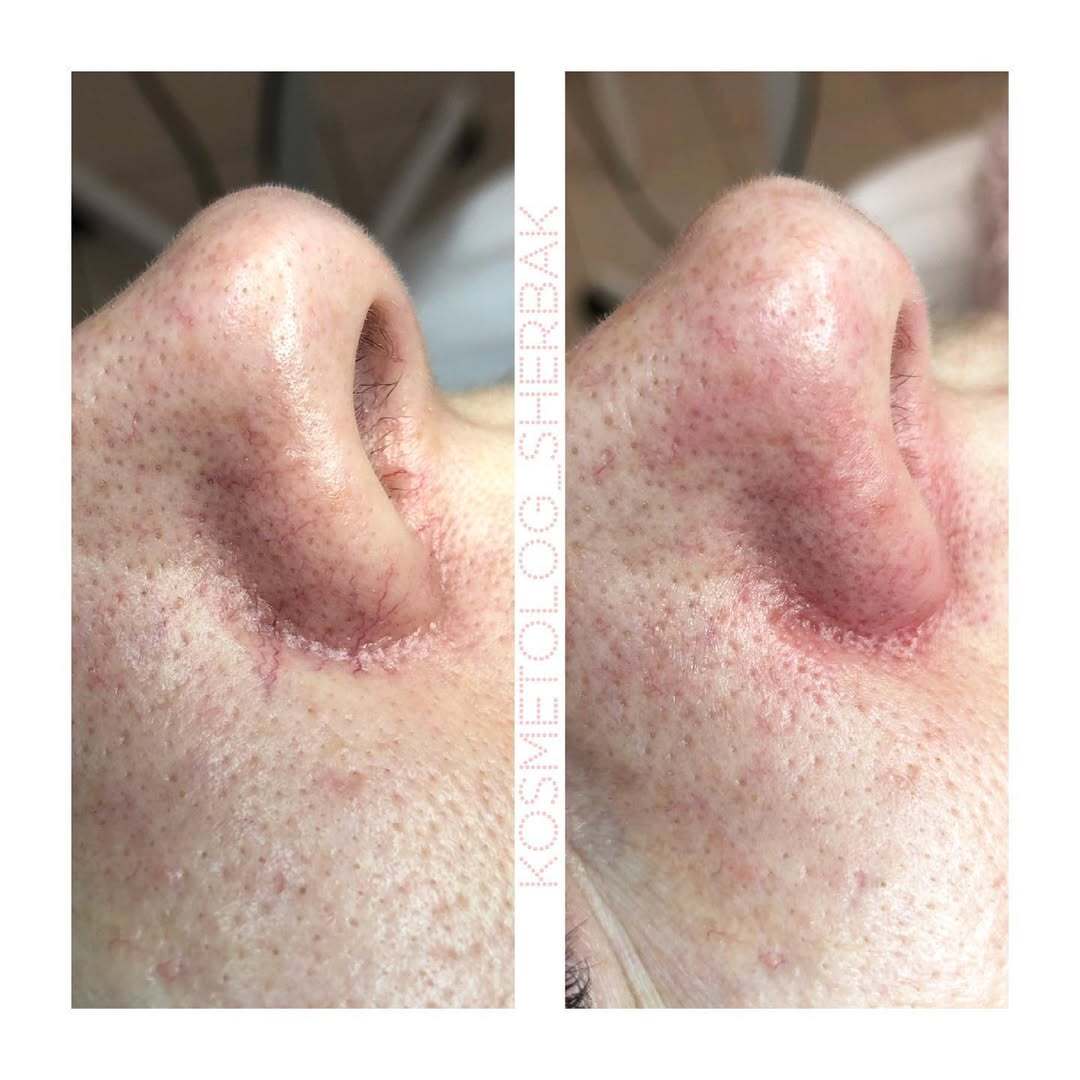 Фото до и после: удаление сосудов лазером в клинике PradusCOSMO, Санкт-Петербург. Безопасно, эффективно и без повреждений кожи