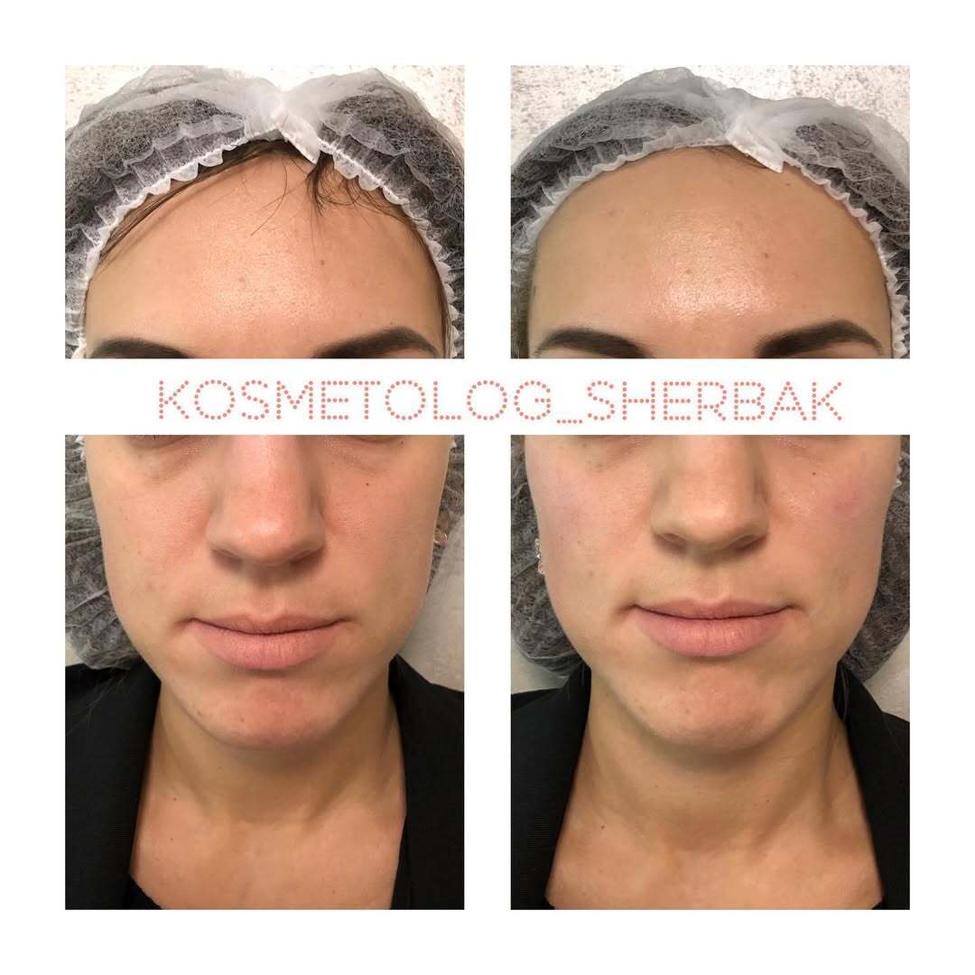 Контурная пластика лица в клинике PradusCOSMO, Санкт-Петербург. Естественный результат без эффекта переделанного лица