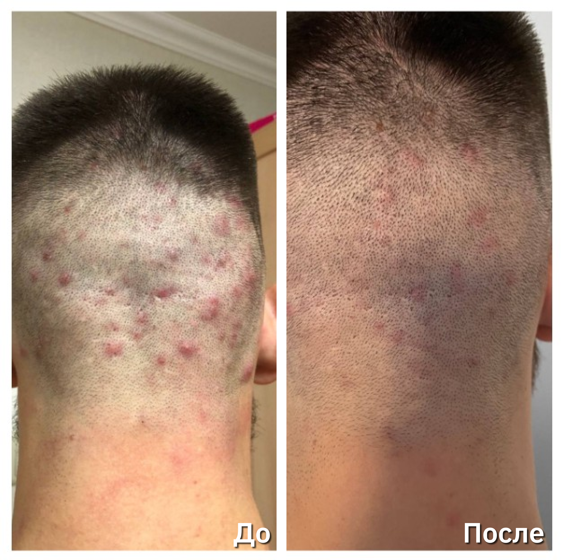 Фотодинамическая терапия REVIXAN - оборудование ФДТ и учебные курсы ...