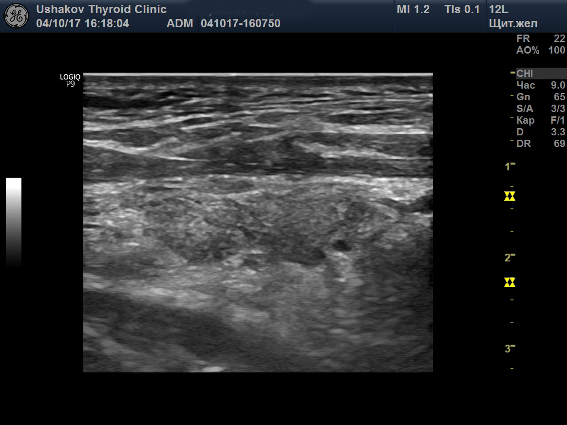 Примеры УЗИ щитовидной железы (с комментариями)