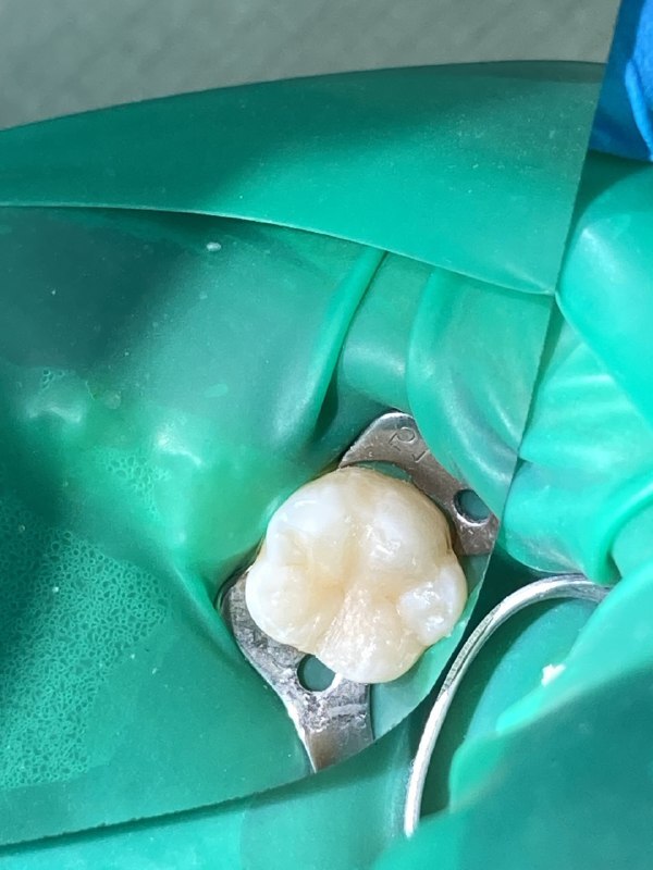 восстановление анатомической формы зуба