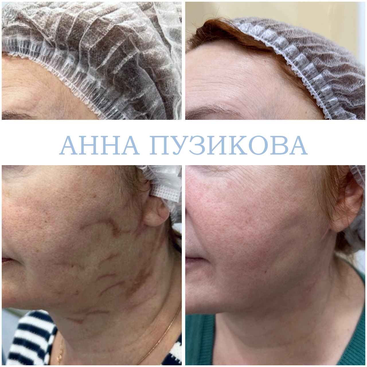 Результат удаления шрама у пациента — косметолог Пузикова Анна Анатольевна, Санкт-Петербург