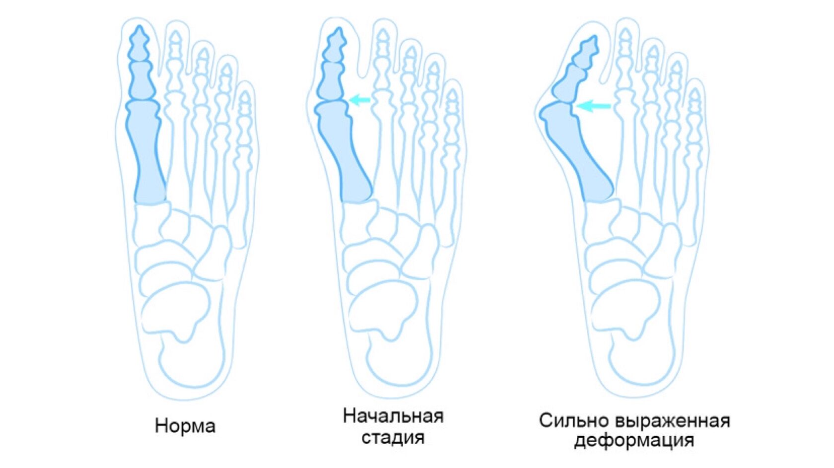 Удалить кости. Норма кости большого пальца на ноге. Удаление косточки на ноге реабилитация.