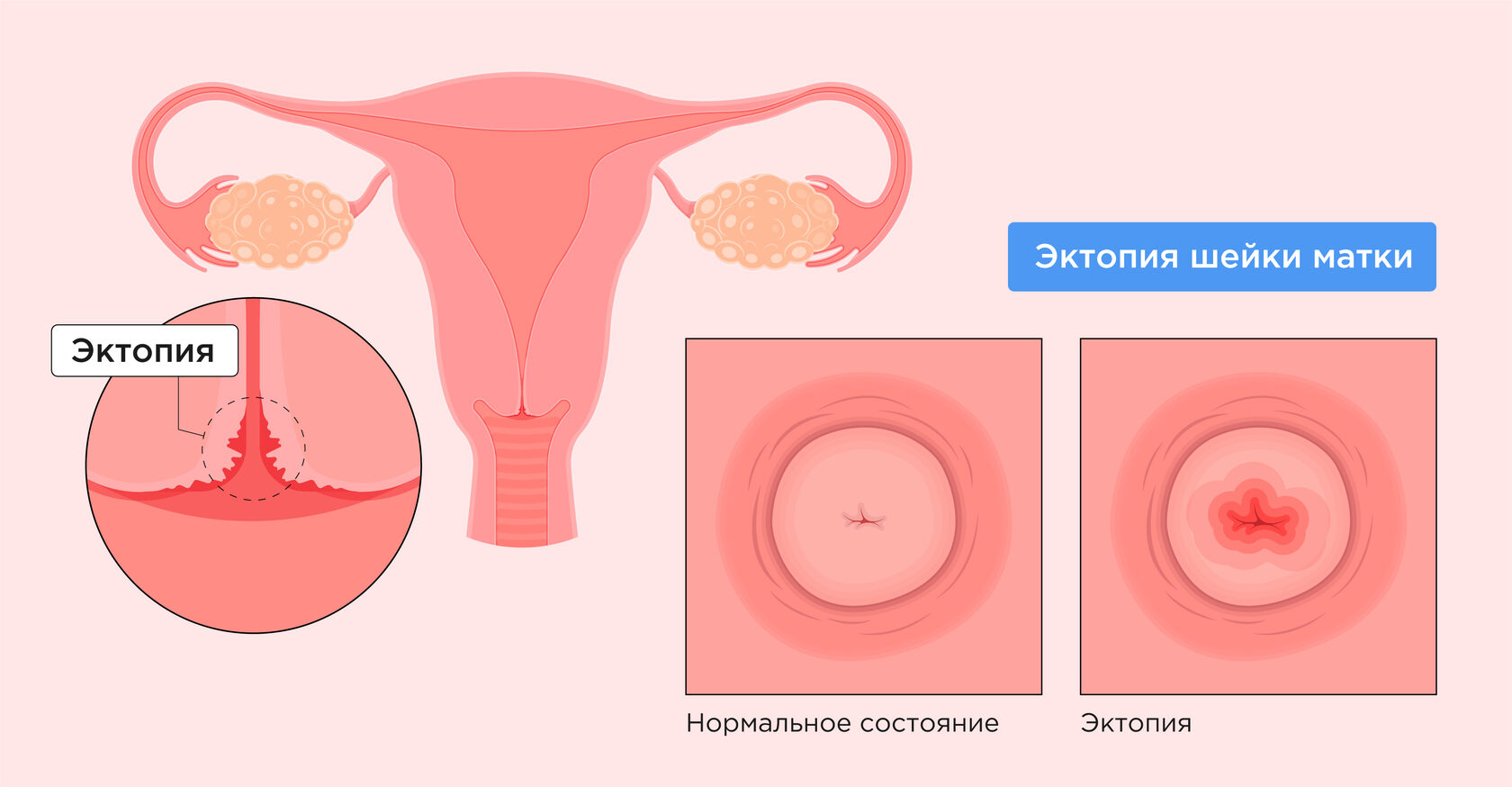 Экстренная контрацепция: как не забеременеть после незащищённого секса - Лайфхакер