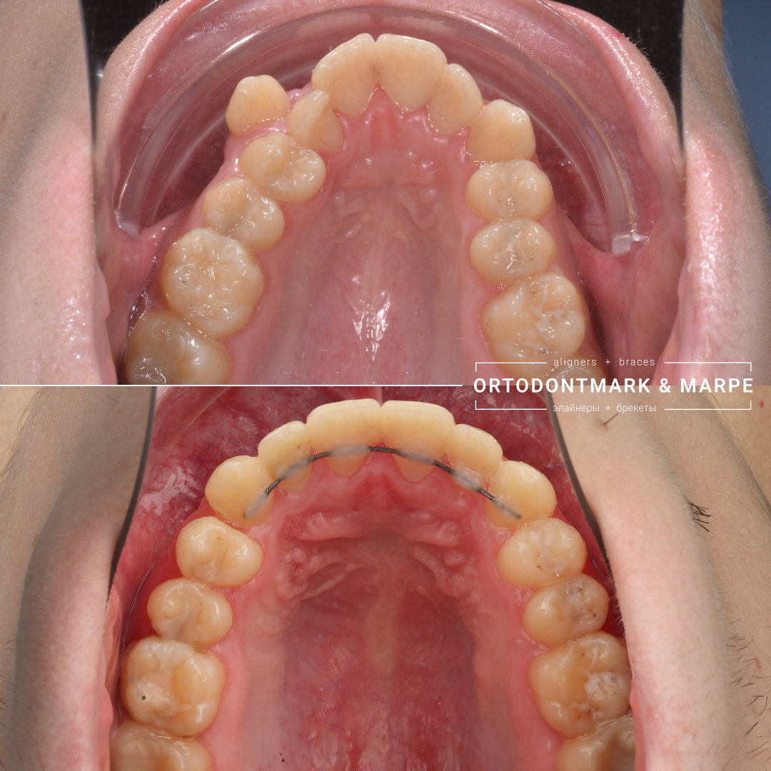 MARPE case result 14