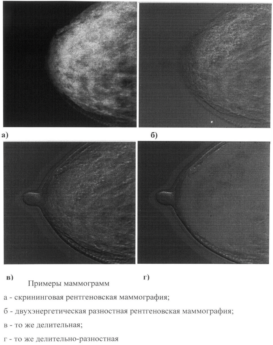 Чем отличается маммография от узи молочных желез. Двухэнергетическая маммография. Маммограмма молочных желез норма. Маммография снимок в норме. Снимок маммографии молочных желез расшифровка норма.