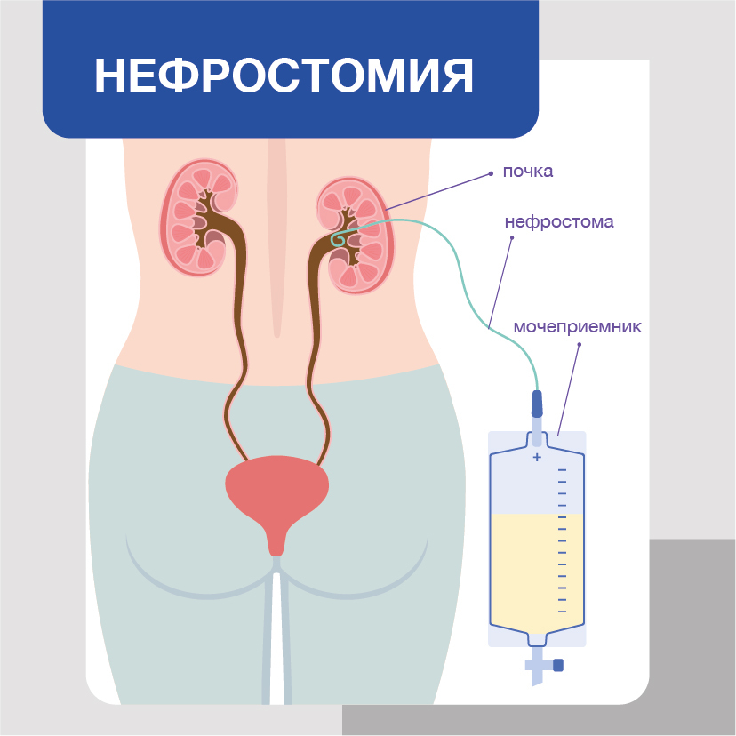 МКБ 10 - Состояние, связанное с наличием искусственного …