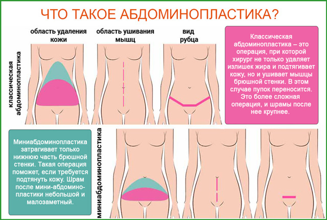 Абдоминопластика схема операции