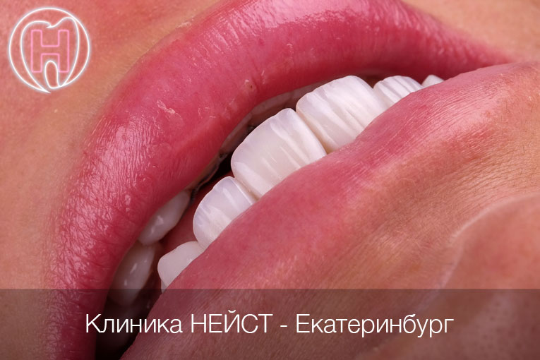 Авторские композитные виниры в Екатеринбурге, цвет Блич 3