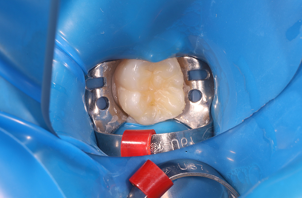 Профилактика кариеса у ребенка через герметизацию