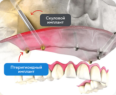 Схема установки птеригоидного импланта