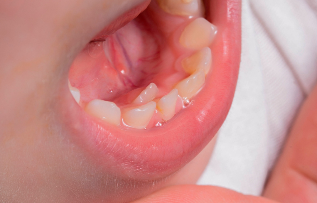 Что делать, если при прорезывании зубов у ребенка появляется кашель?