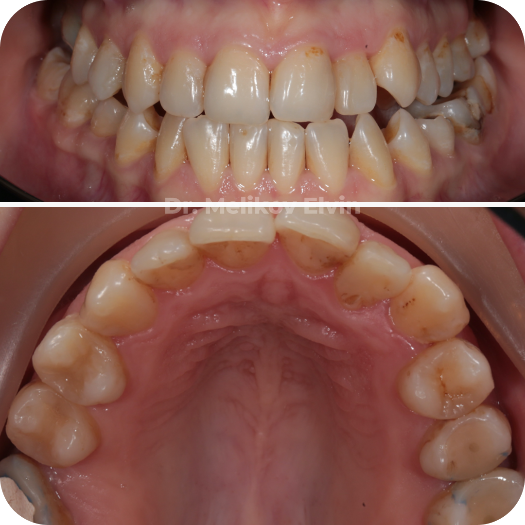 Фотографии до операции по расширению верхней челюсти.