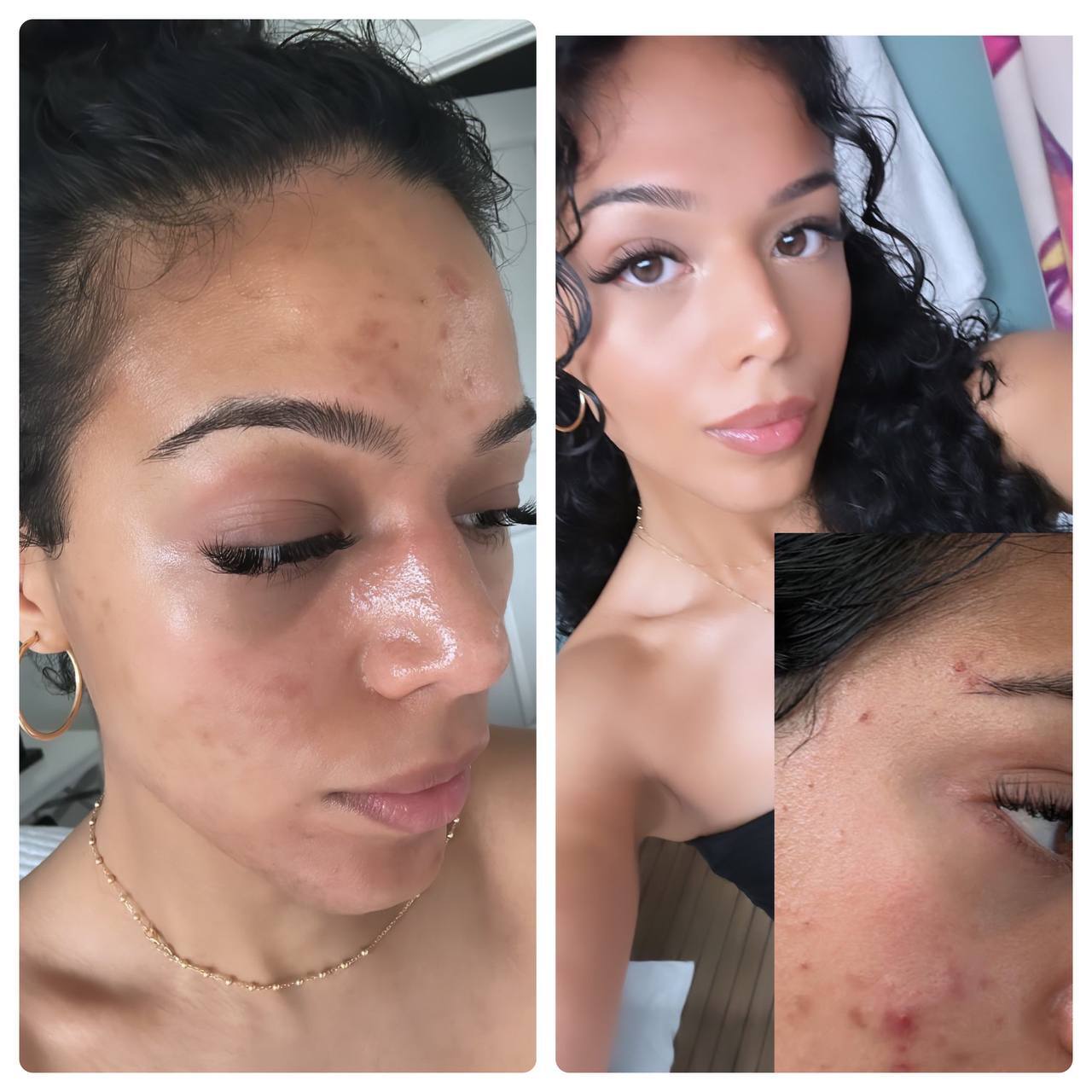 Before and after — post-acne skin fully transformed after 9 months of Red Carpet Facial and European Facial treatments at Beauty Studio by Hanna, Mount Pleasant SC