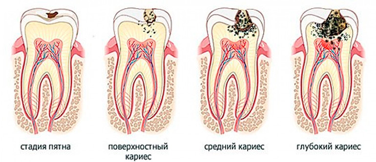 Этапы лечения кариеса цемента