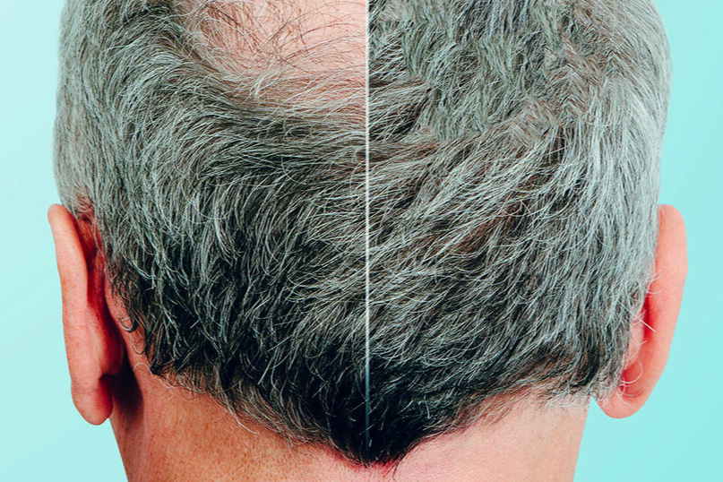 Пересадка волос