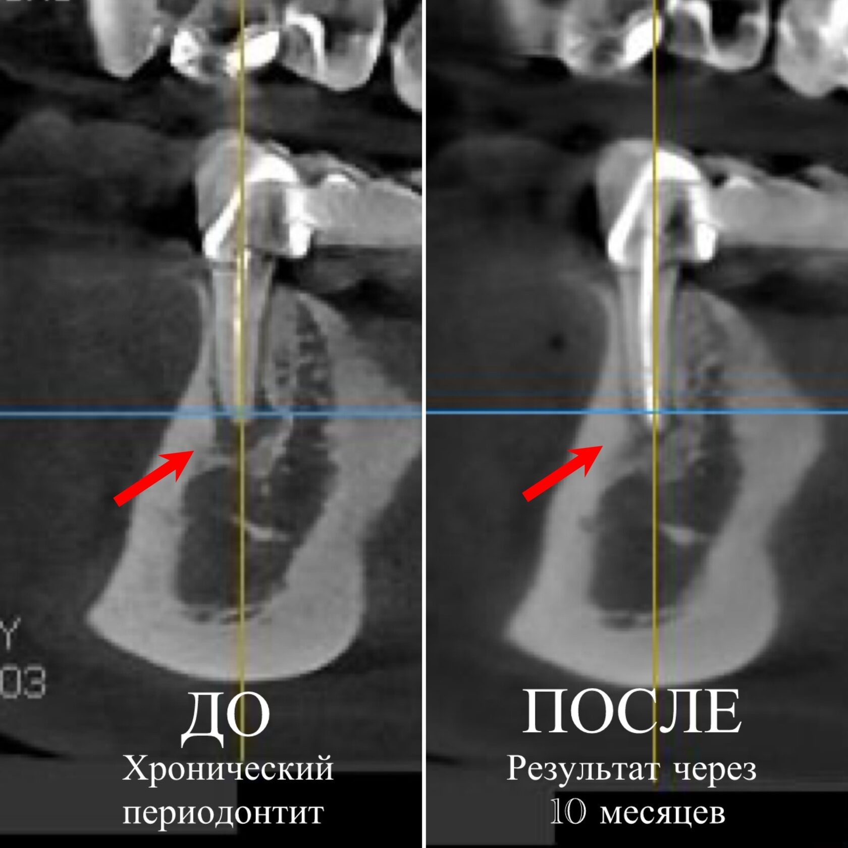 Лечение кисты