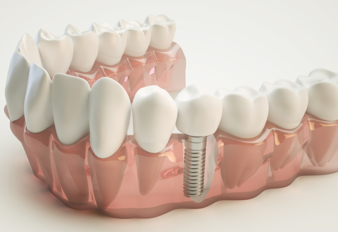 Зуб имплант сочи. Лакримальный имплантат. Студия улыбок сочи. Акция на имплантацию зубов. Импланты дентиум.