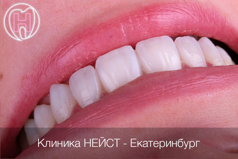 Композитные виниры c прозрачным краем в Екатеринбурге, цвет Блич 4