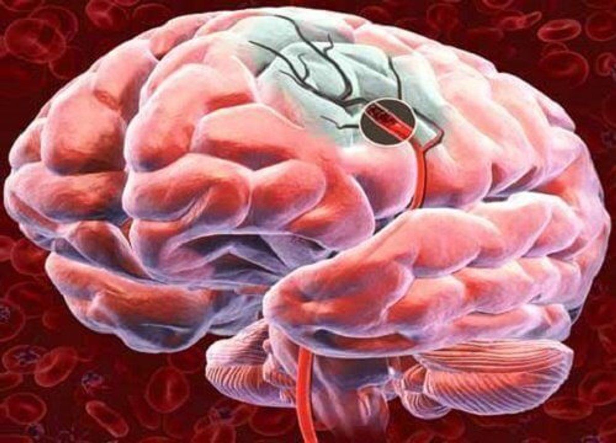Нарушения кровообращения мозга в неврологии: причины и симптомы, инсульты,  методы лечения