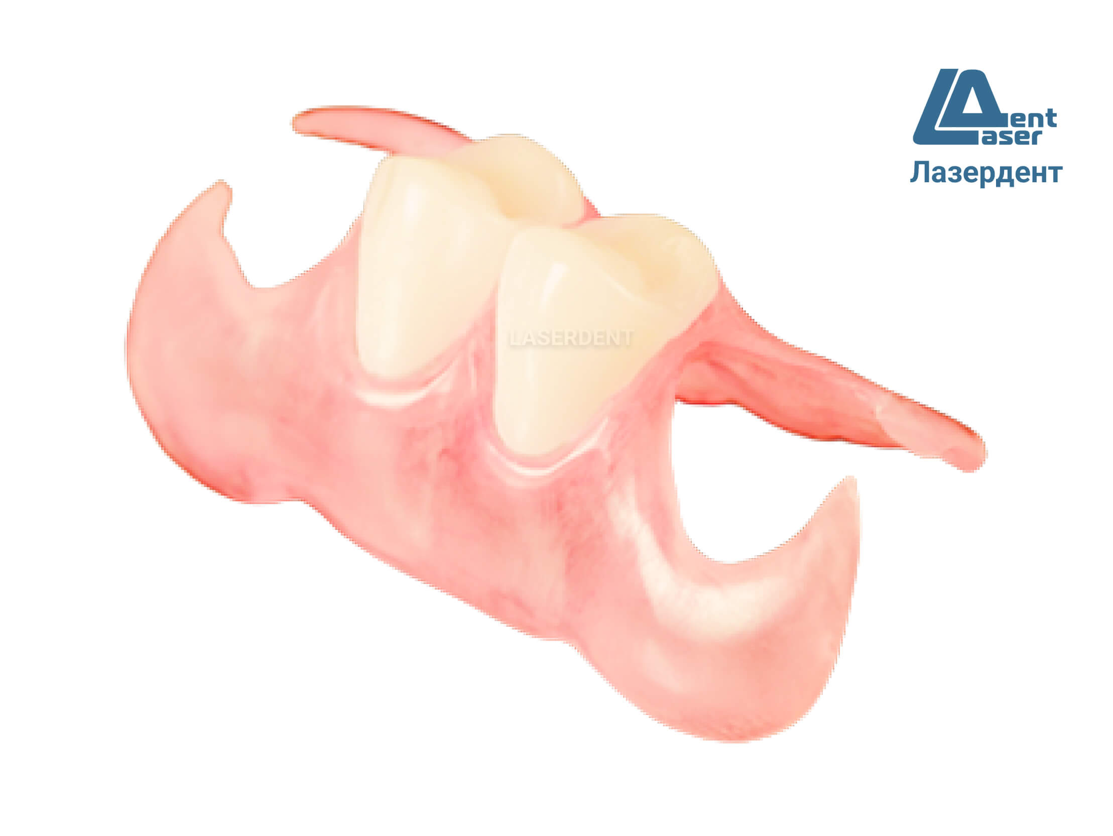 Косметический протез зубов | Стоматологическая клиника Культура