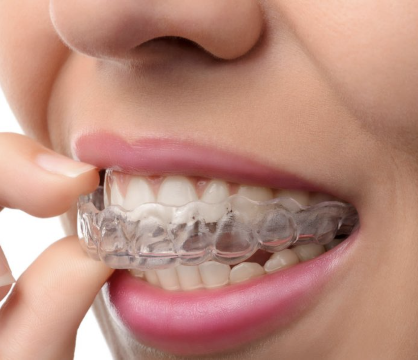 Брекеты плюсы и минусы. Каппы Инвизилайн. Элайнеры Invisalign. Ортодонт каппы элайнеры. Элайнеры Invisalign (Инвизилайн).