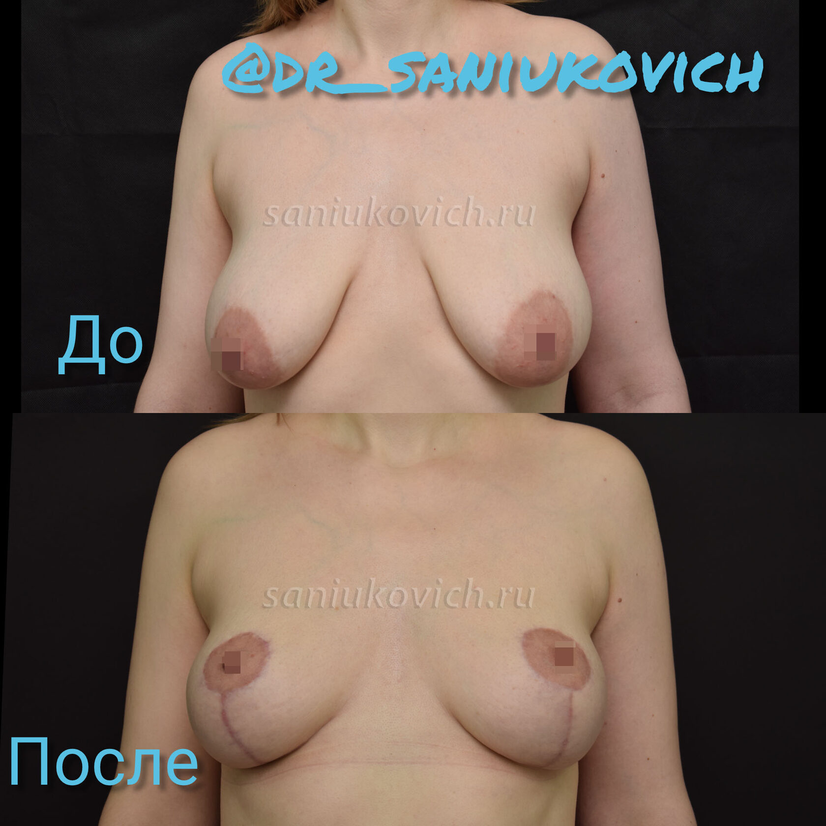 подтяжка груди женщин в домашних условиях фото 113