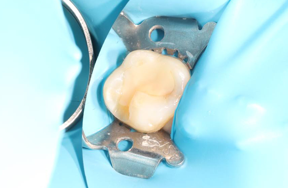 Восстановление жевательного зуба после скола старой пломбы