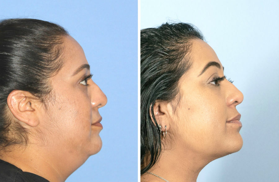 Хирургическая подтяжка кожи до и после