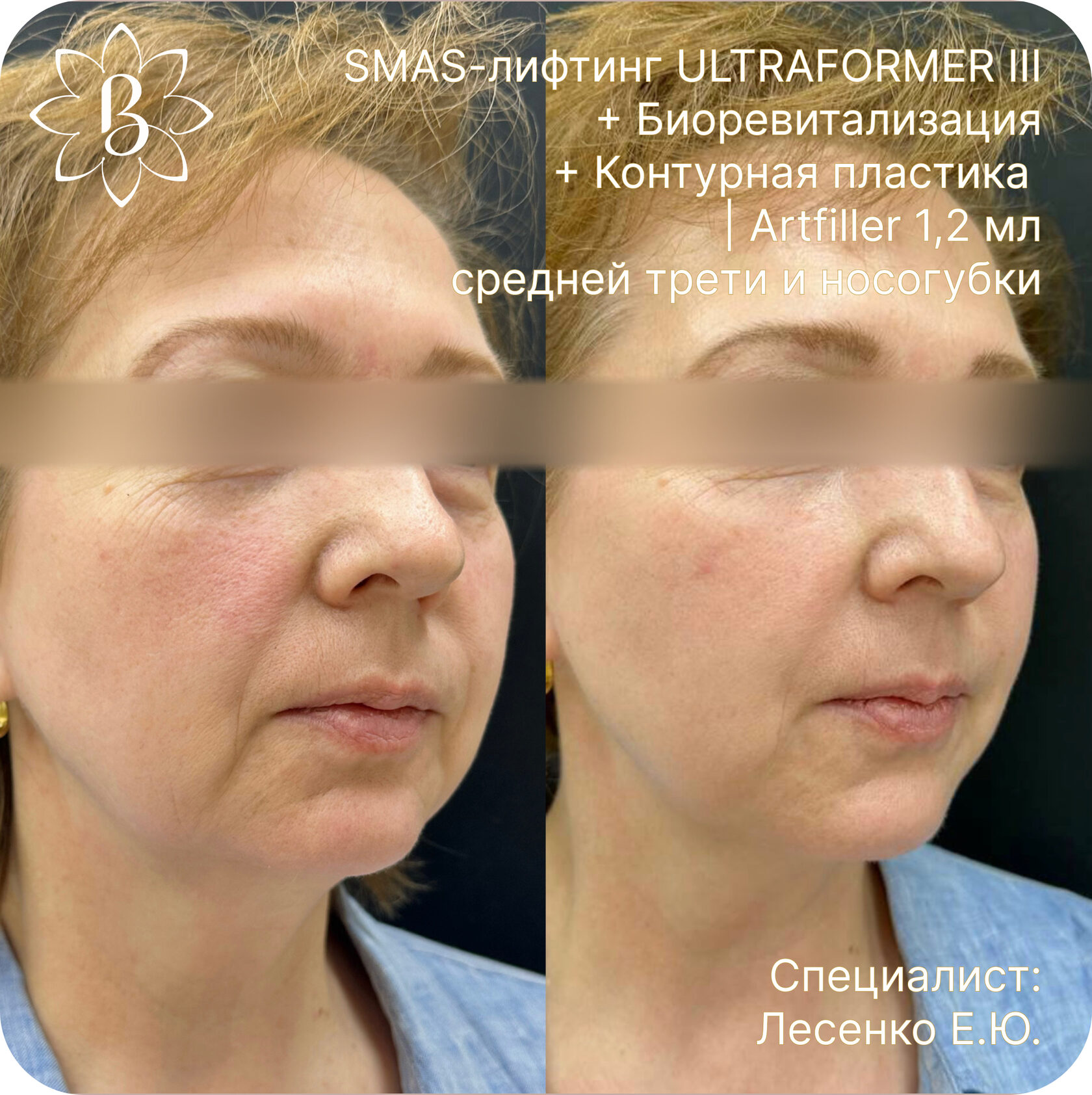 Александритовая лазерная эпиляция