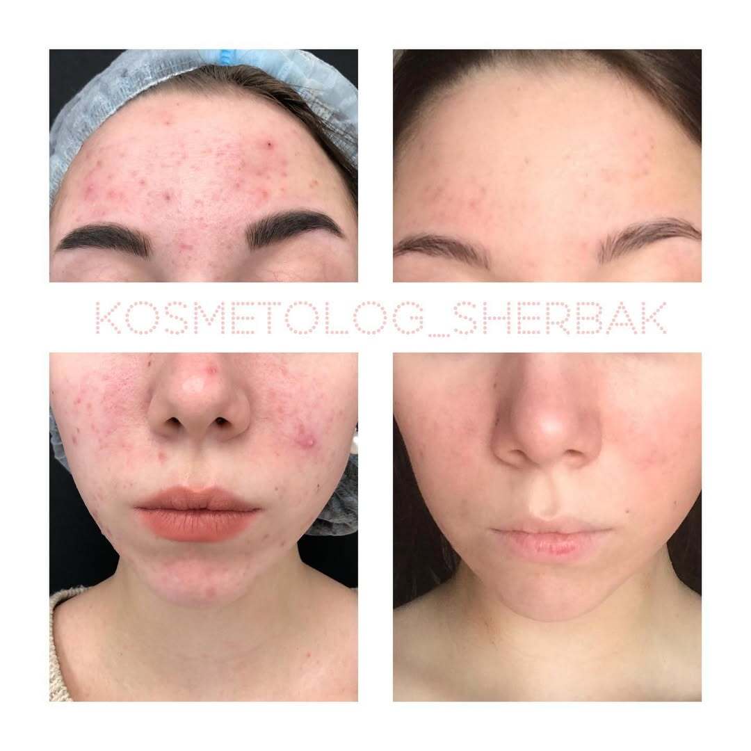 Лечение акне у женщины в клинике PradusCOSMO, СПб. До и после процедуры