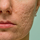 rf-лифтинг акне