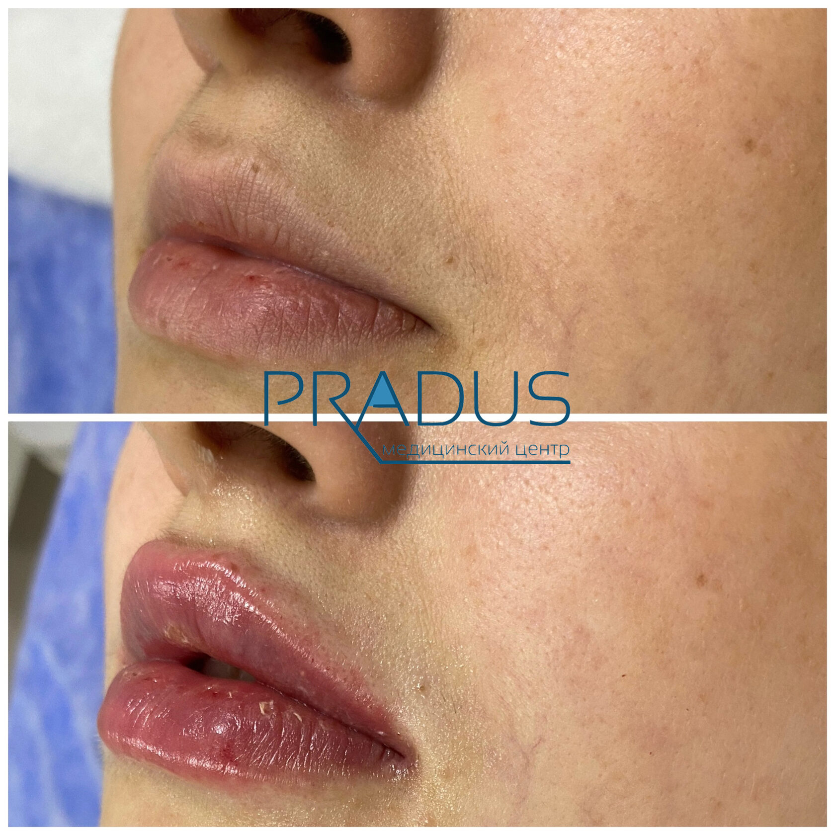 До и после контурной пластики губ. Увеличение объёма без утяжеления. PradusCOSMO, Васильевский остров