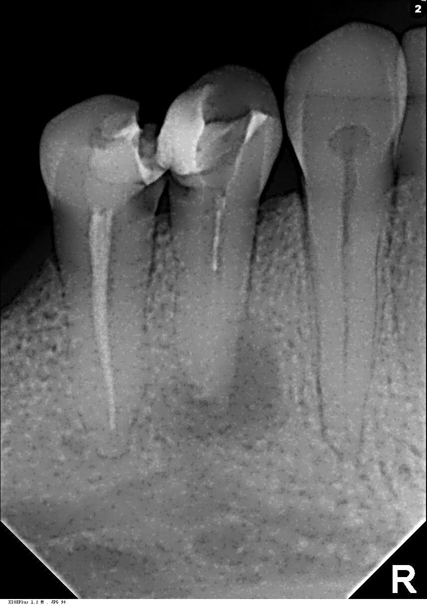 Периодонтит это. Апикальный периодонтит рентген. Периодонтит зуба рентген. Мышьяковый периодонтит.