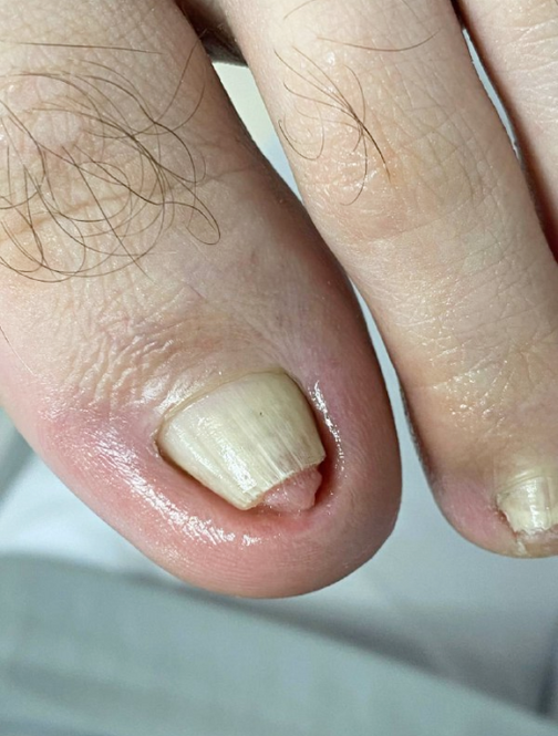 Почему появляются продольные борозды на ногтях и как от них избавиться?