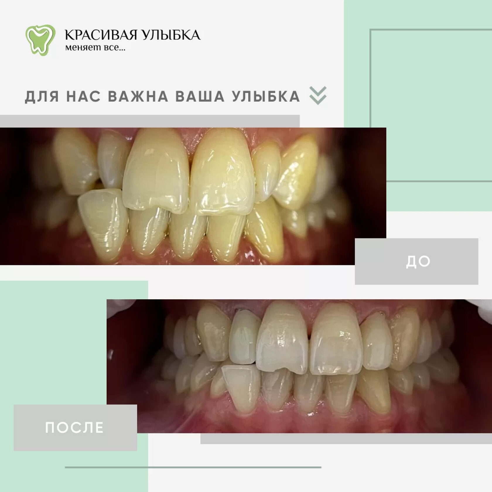 Циркониевые коронки цветовая гамма