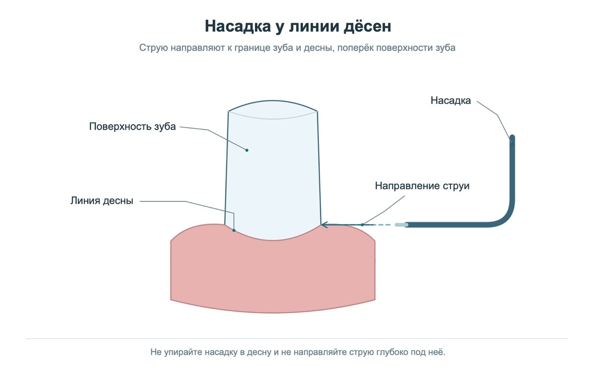 Положение насадки ирригатора у линии дёсен