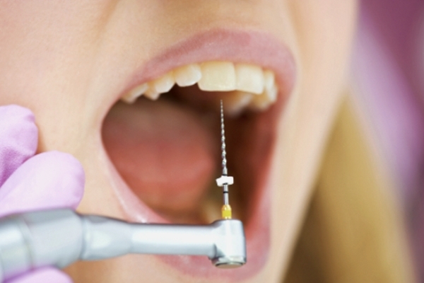 Как предотвратить лечение каналов зуба?