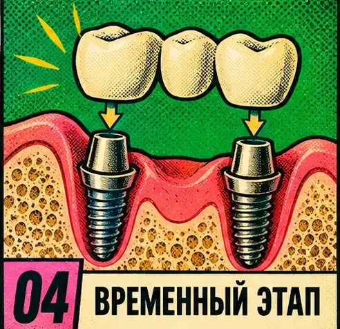 Временная конструкция на имплантах