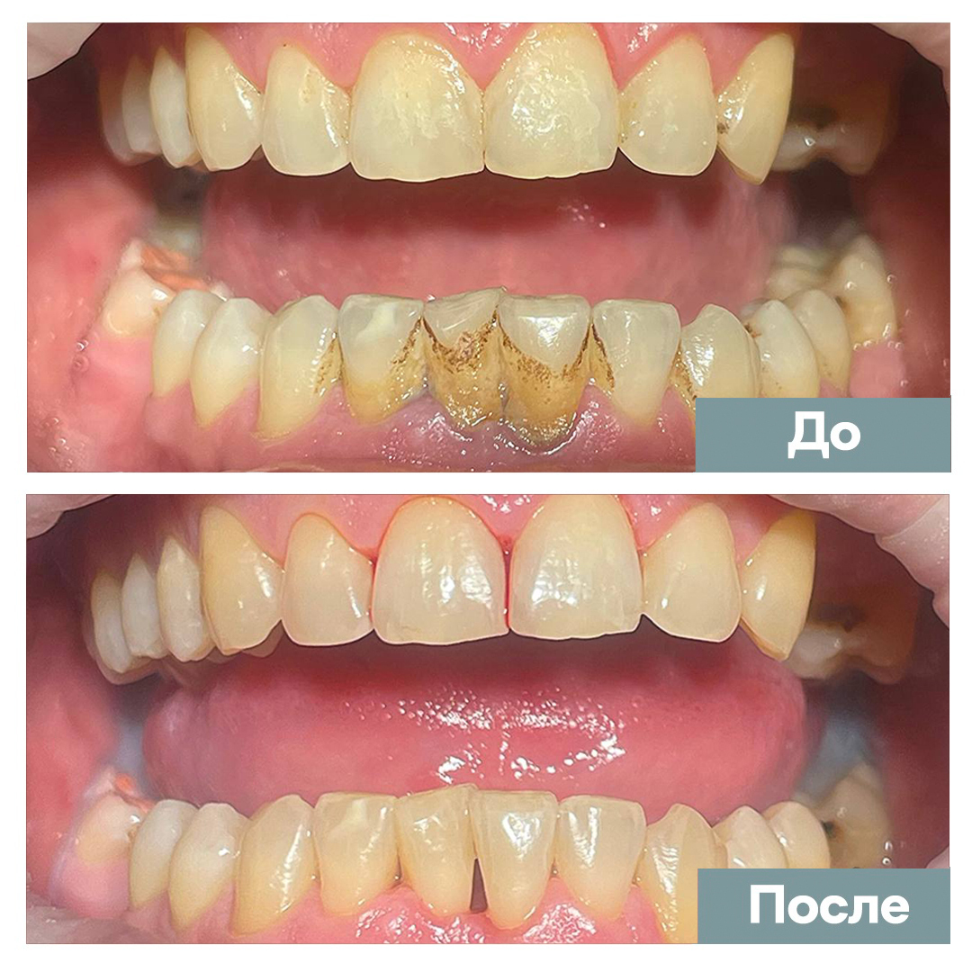 чистка зубного камня