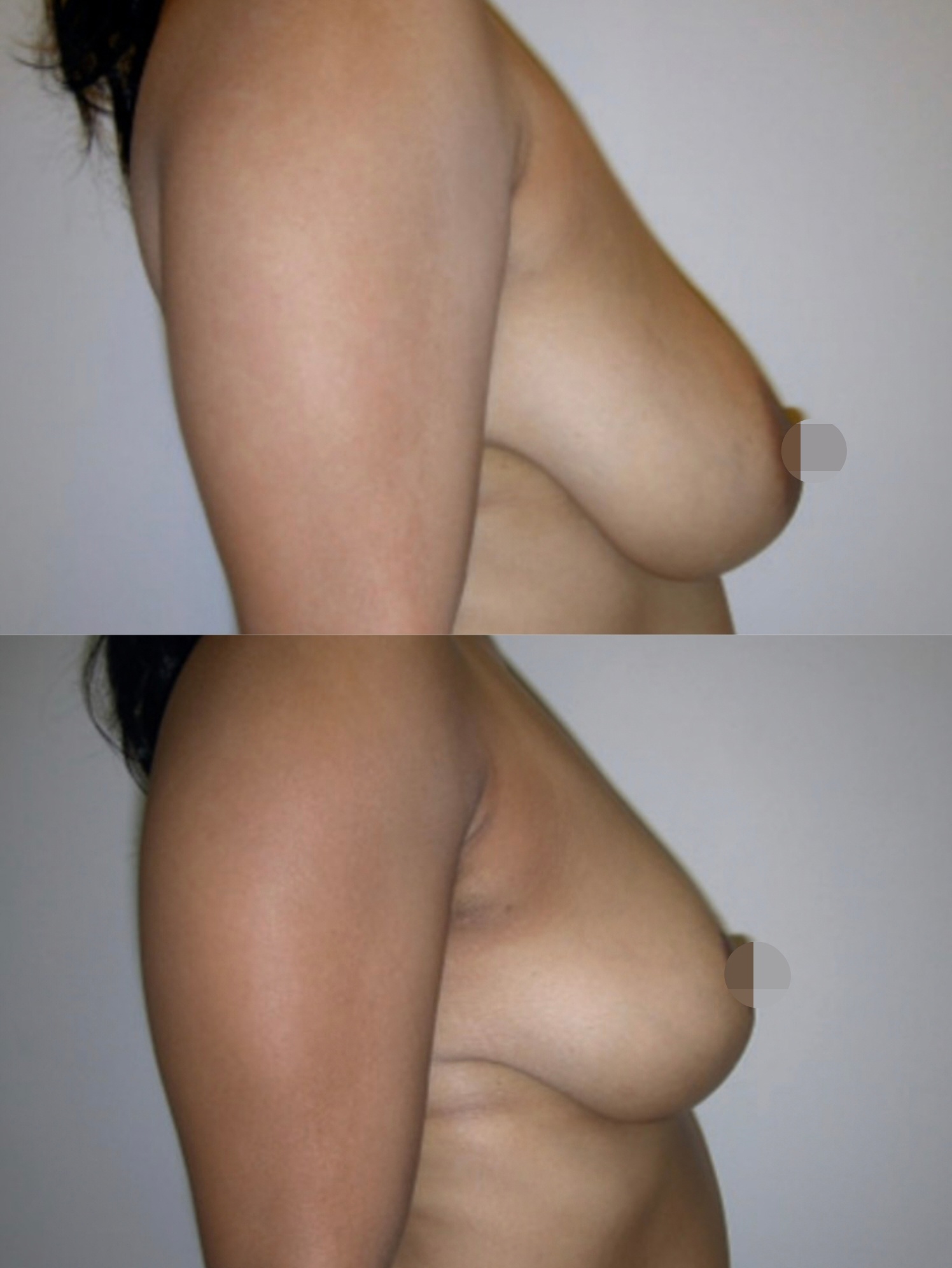 уменьшение размера груди операцией фото 43