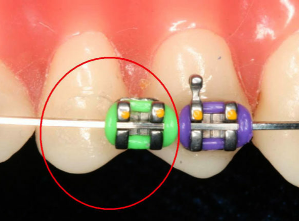 На что крепятся брекеты к зубам. Смотреть фото На что крепятся брекеты к зубам. Смотреть картинку На что крепятся брекеты к зубам. Картинка про На что крепятся брекеты к зубам. Фото На что крепятся брекеты к зубам
