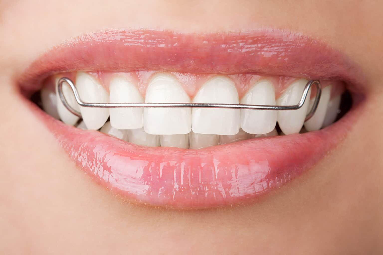 Что такое ортодонт. Пластинка ретейнер ортодонтическая. Пластина для выпрямления зубов. Скобы пластинки для зубов. Скобы для выпрямления зубов.