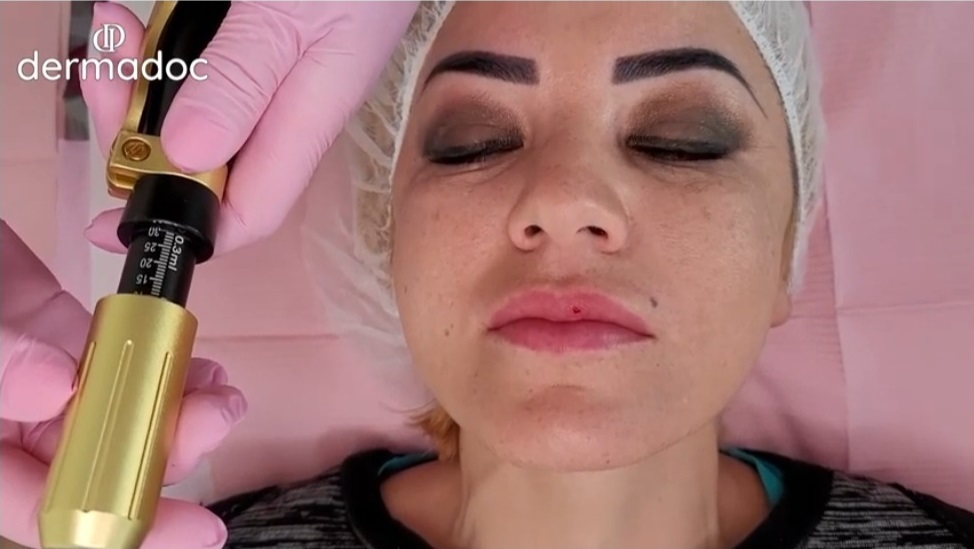 Hyaluron Pen Online Training